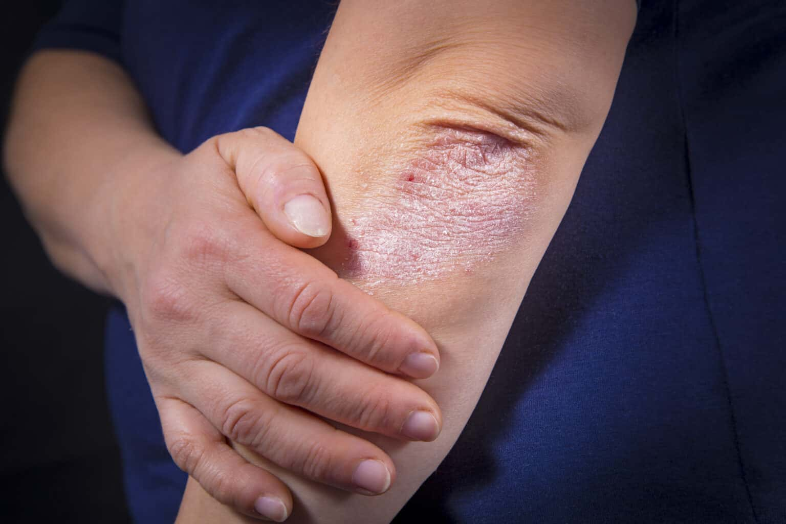 here-are-four-easy-ways-to-manage-a-psoriasis-flare-up